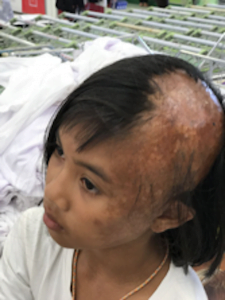 Boil a burned Isan girl from Surin